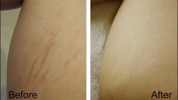 mederma stretch mark therapy reviews before and after